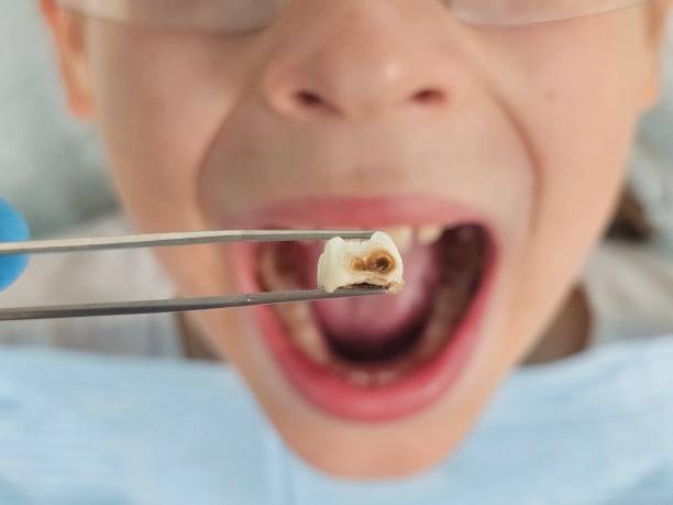 Best Broken or Chipped Tooth Repair in Ragland, AL